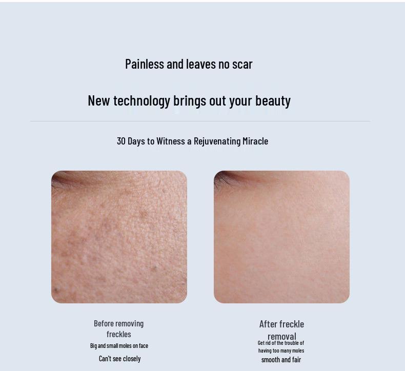 Лазерная ручка Aurora LCD для удаления родинок и веснушек - Косметический прибор для домашнего использования