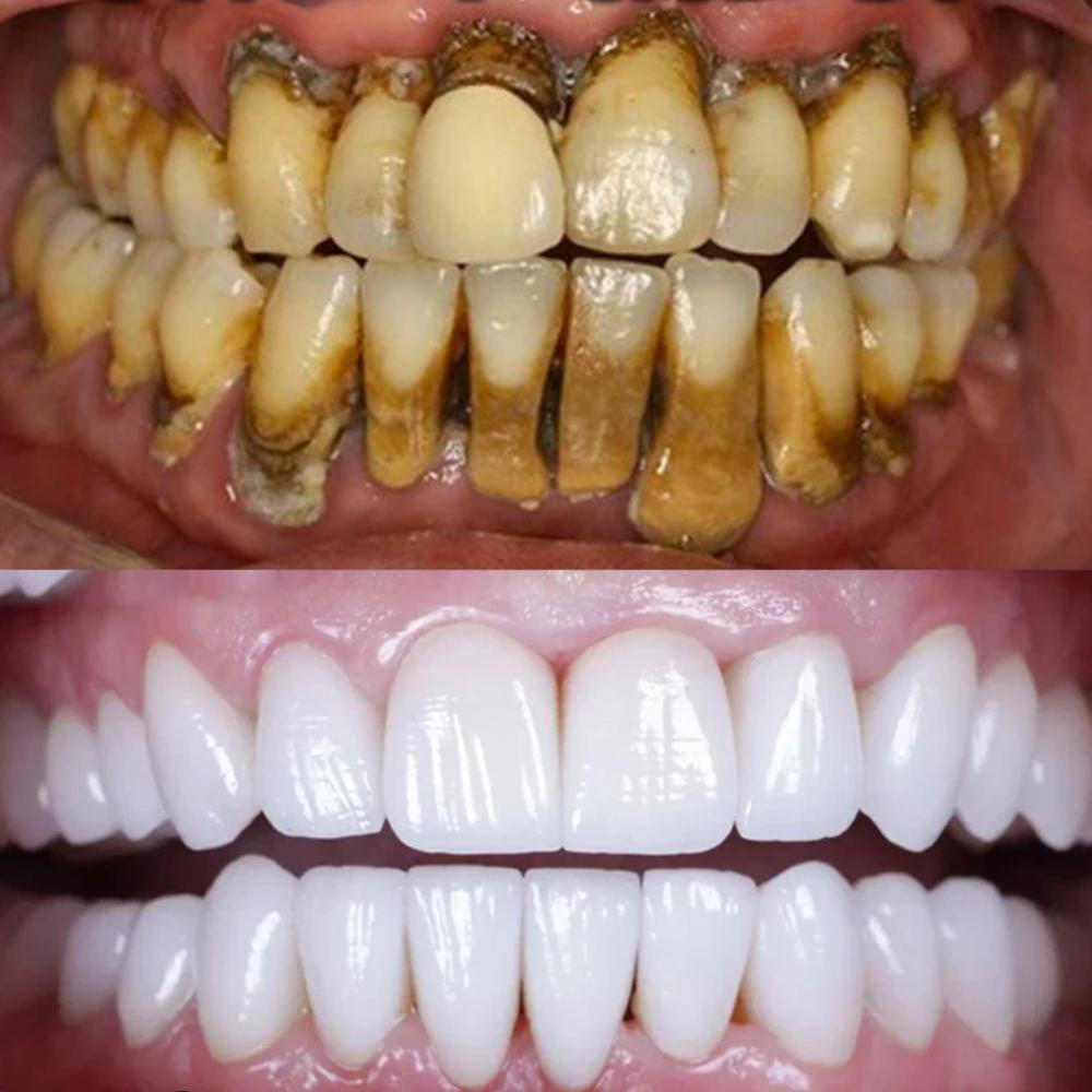 100g Whitening Toothpaste Remover Dental Calculus Whitening Teeth Mouth Odor Removal Bad Breath Preventing Periodontitis