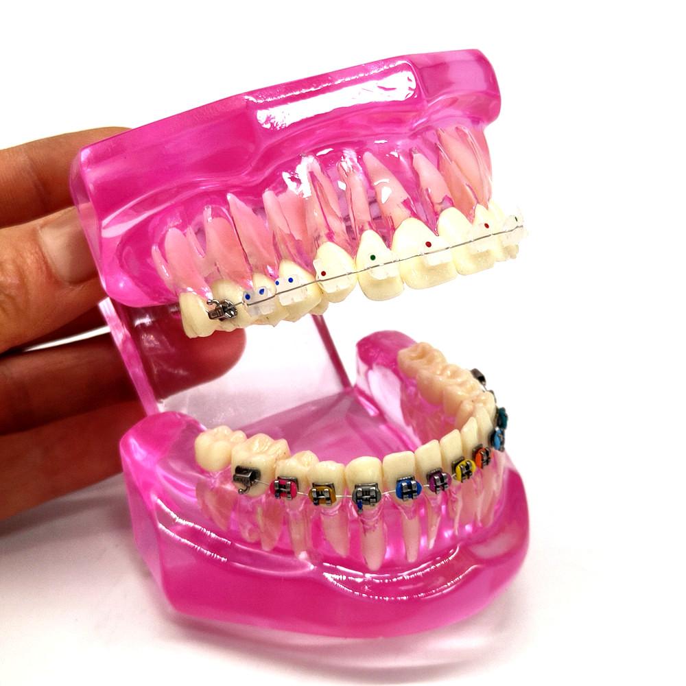 1 шт., стоматологическая ортодонтическая модель, связь с пациентом, 2 вида брекетов с дугами, лигатуры, керамический брекет, металлический краевой брекет