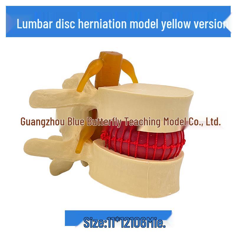 Подлинная модель протрузии поясничного отдела позвоночника и патологии позвонка