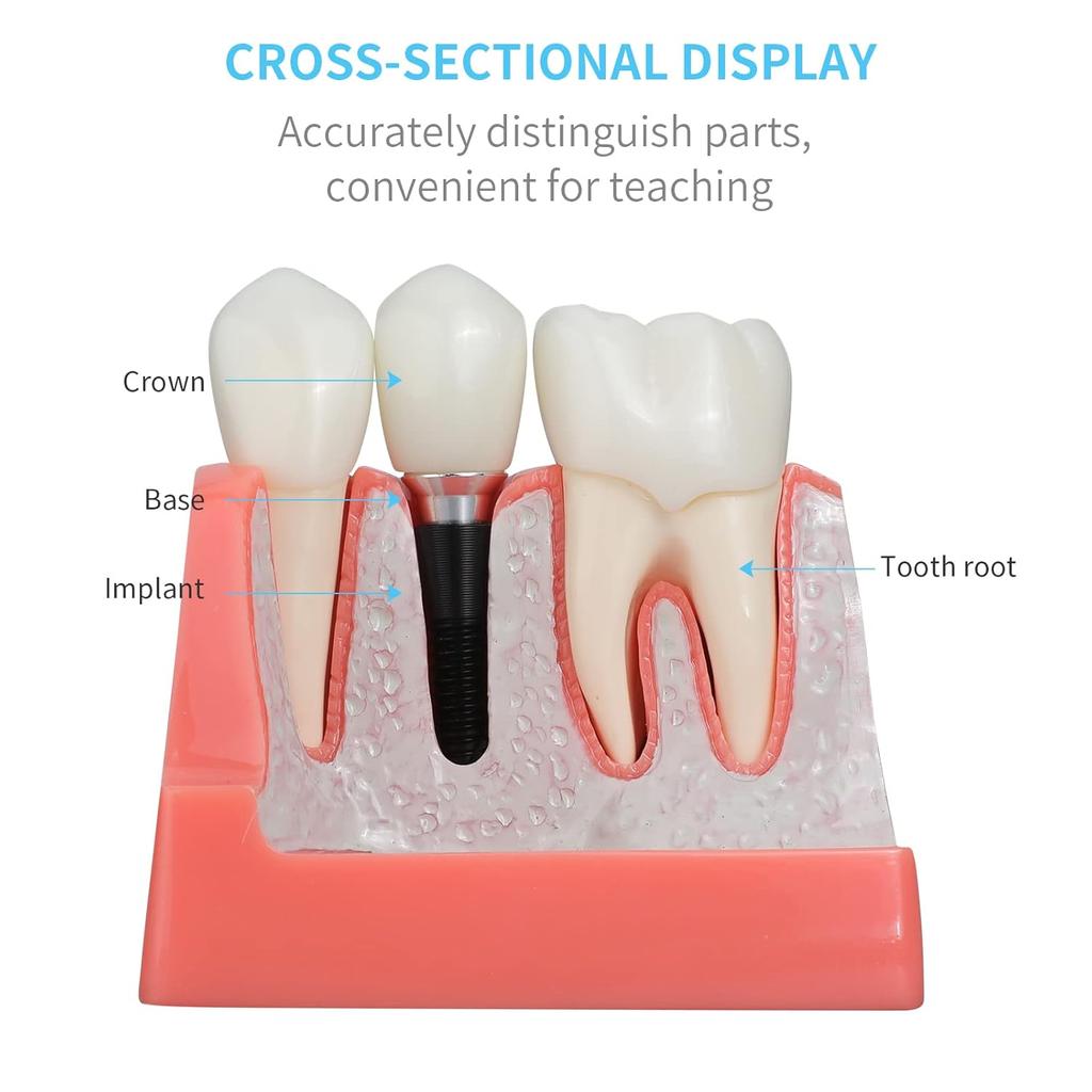 ANNWAN Dental Implant Model 4 Times Removable Analysis Crown Bridge Demonstration Teeth Model for Class Education and Studying Teeth Model