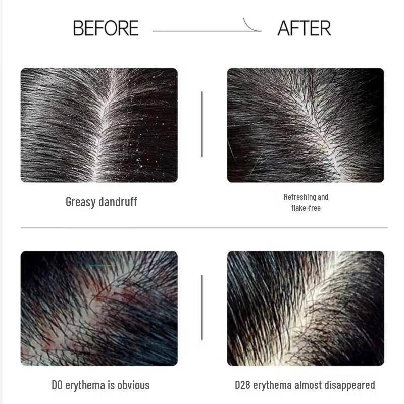 Spes Bisabolol Polypeptide Anti-Dandruff Shampoo