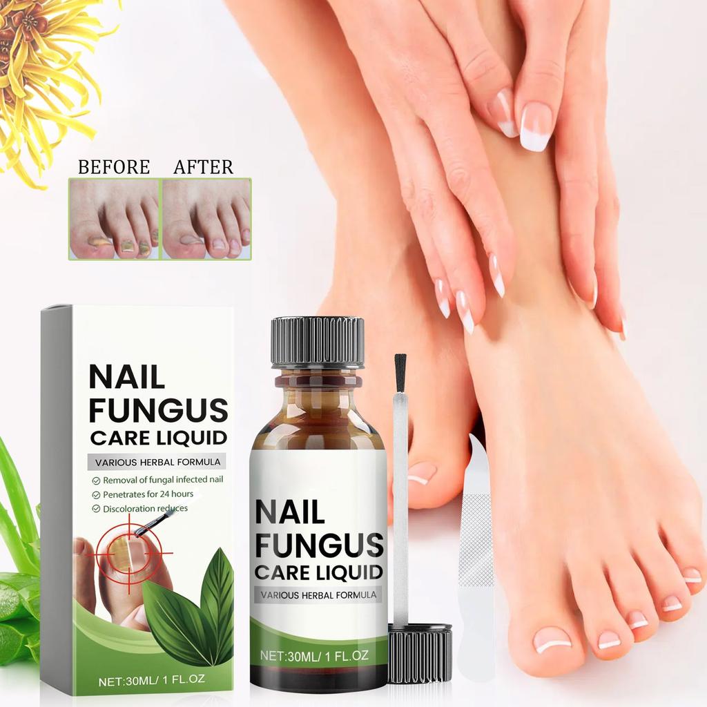 Toenail Fungus TreatmentExtra Strong, NailTreatment, Nail Care TreatmentExtra Strong For Thick, Discolored And Damaged Nails,30ml
