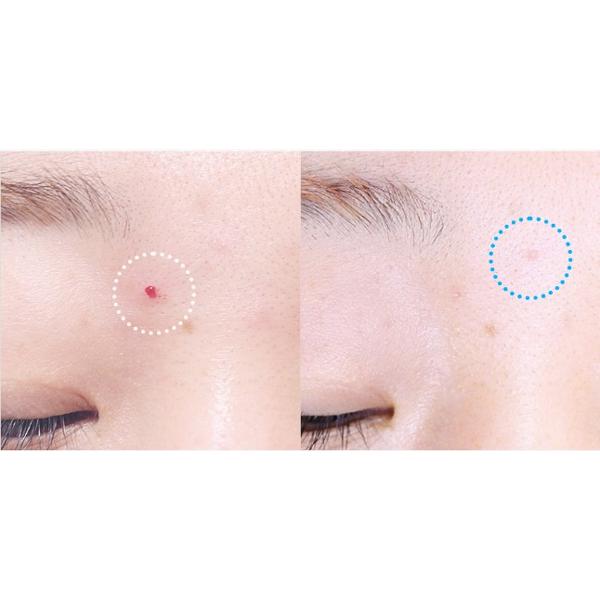 HATHERINE Spot Care Patch Kit (2 Types Spot Patch Duo) 76 Patches