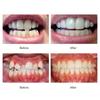 Dental Appliance Tooth Orthodontic Braces Trainer Dental Braces Teeth Trainer Alignment Braces Mouthpiece For Adults Orthodontic