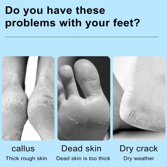 Набор для удаления мозолей, профессиональная шлифовальная машинка для ног из нержавеющей стали, ловушка омертвевшей кожи