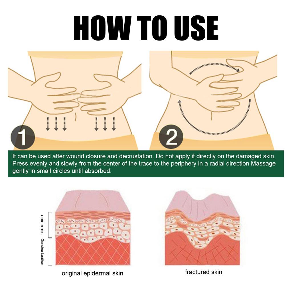 Предотвращение растяжек Предотвращение и исчезновение растяжек Удаление шрамов от растяжек Растяжки для мамочек и матерей