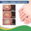 50 Pcs/Set Nail Ingrown Stickers Double-sided Adhesive Ingrown Toenail Correction Ingrown Toenail Correction Tool Elastic Patch Stickers