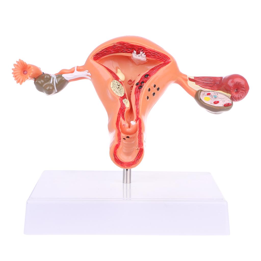 Pathological Uterus Ovary Anatomical Model Anatomy Cross Section Study Tool
