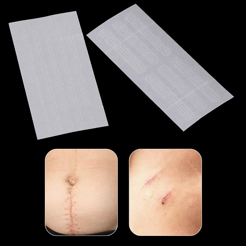 Полоски для закрытия ран Хирургические швы Послеродовое лечение ран Косметическая хирургия Клей Медицинское здравоохранение