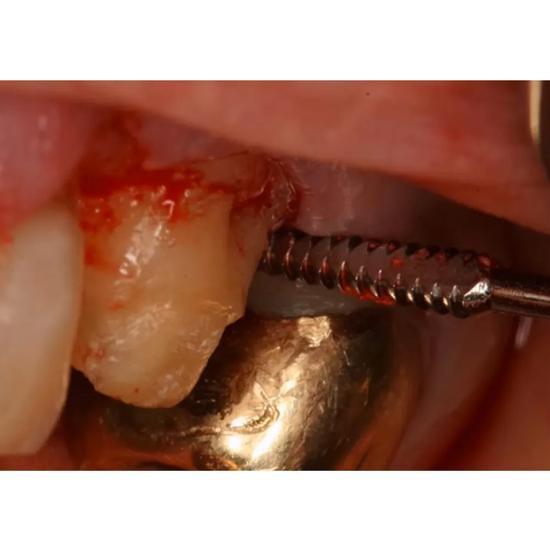 Костный напильник GDC Periodontal Sugarman #6 (Fs3/4s)
