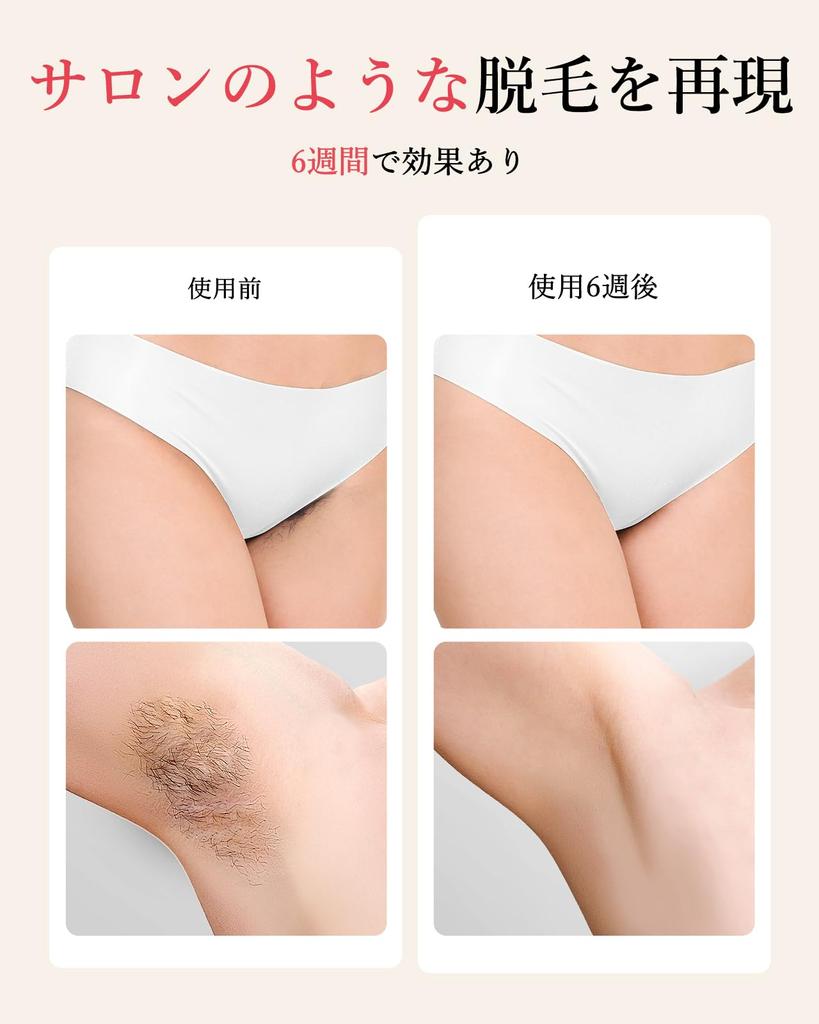 YOZEE Hair Removal Device Output 22J Large Area Light Output Home Use Hair Removal Device Automatic Irradiation Number of Irradiations IGBT Painless