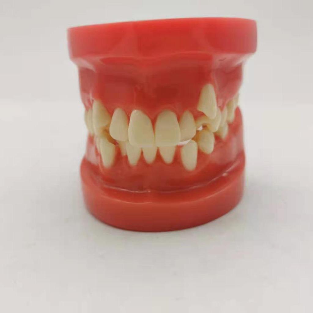 Children's Dental Malocclusion Teaching Model - Red Protrusion