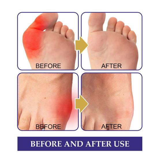 Пластырь для ухода за ногами, 5 шт./кор., эффективный, надежный, не раздражающий, безопасный, тонкая работа, снимает отек, нетканый материал, пластырь для ног против бурсита для дома
