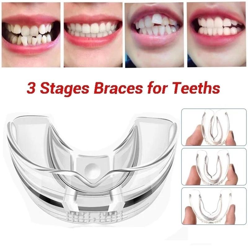Dental Orthodontic Teeth Corrector Braces Retainer Straighten Tools Tooth Care