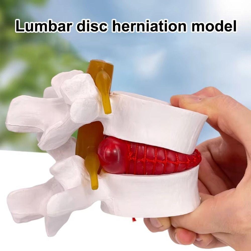 3D Model Human Anatomy Skeleton Model Lumbar Disc Herniation Teaching Tool Nursing