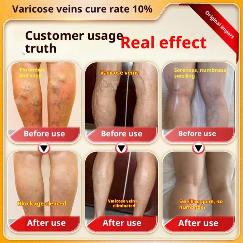 Пластырь для облегчения варикозного расширения вен: Специализированный охлаждающий гель-патч для очищения закупоренных и выпирающих кровеносных сосудов при сосудистых звездочках