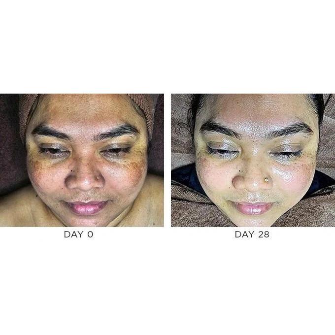 Biluma Skin Brightening Cream | For Even Skin Tone & Glow - 15gm x 2 pcs