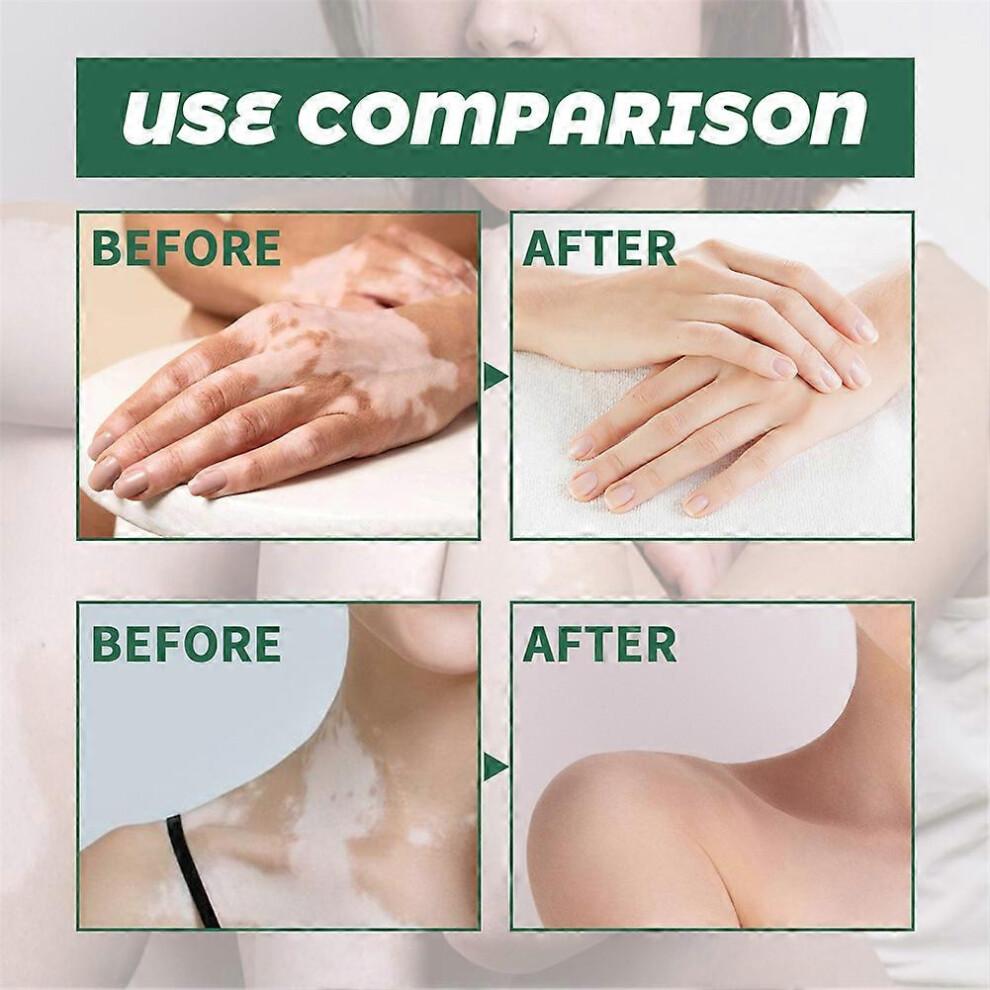 2pcs Vitiligo Skin Repair Cream,Vitiligo Treatment Cream, Dispose of White Spots on Skin and Improve Skin Pigmentation