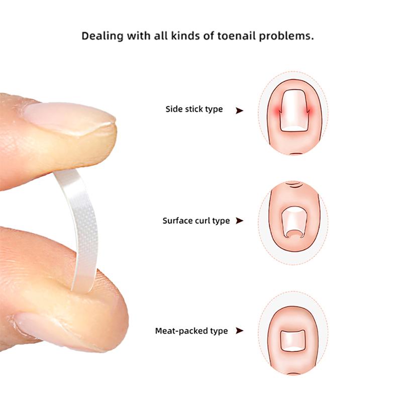 10 шт. Лечение вросшего ногтя Инструмент для коррекции вросшего ногтя Эластичный пластырь Наклейка Выпрямляющий зажим Скоба Инструменты для педикюра