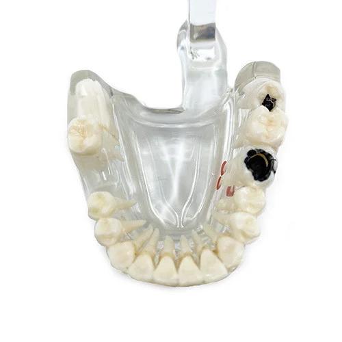 Dental Educational Model, Zamo®, Used To Exemplify Dental Pathologies, 31 Teeth, Transparent