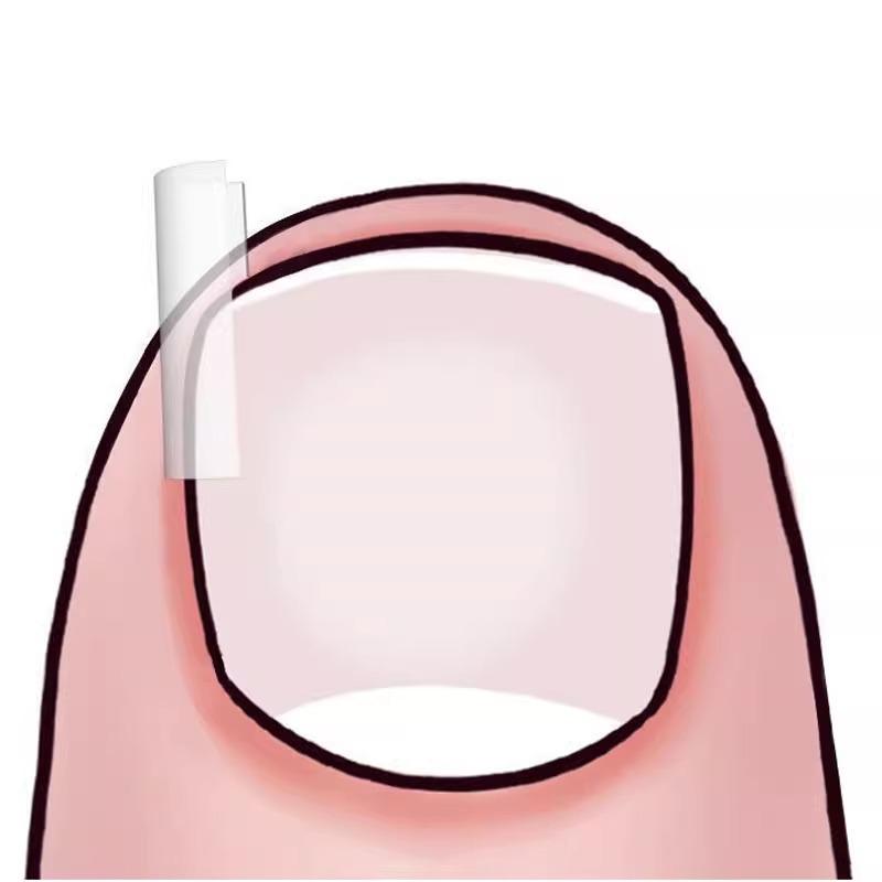 Пластыри для коррекции вросшего ногтя — пластыри для заполнения бороздок, изоляции и снятия воспаления.