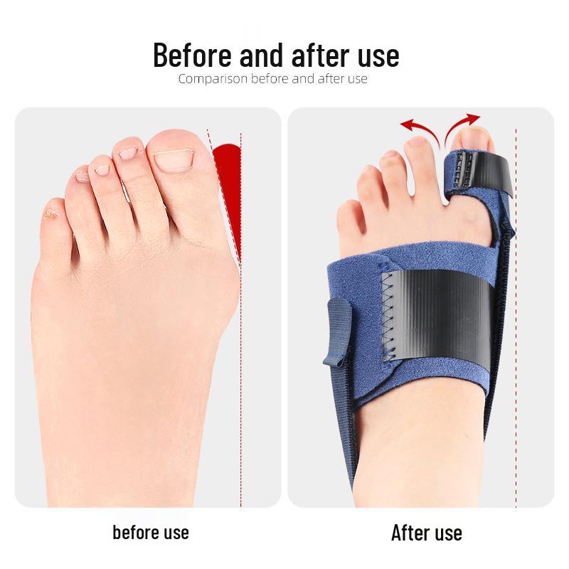 Bunion Relief Toe Separator: Night-use Corrector Strap for Big Toe Alignment