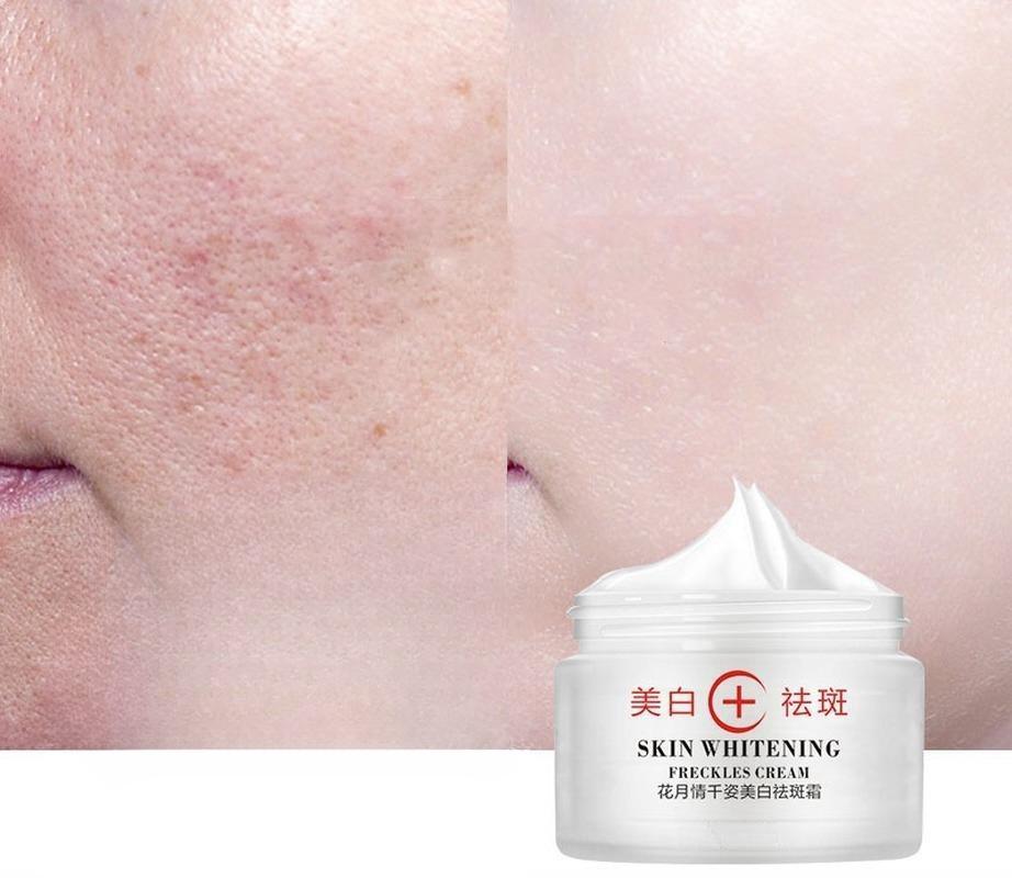 Отбеливающий крем высшего качества, крем для удаления темных пятен, крем для удаления пигмента, мелазмы и веснушек