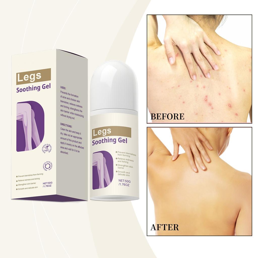 Skin Soothing Gel Acne Relief Redness Itching Coolings Soothing Repairs Gel