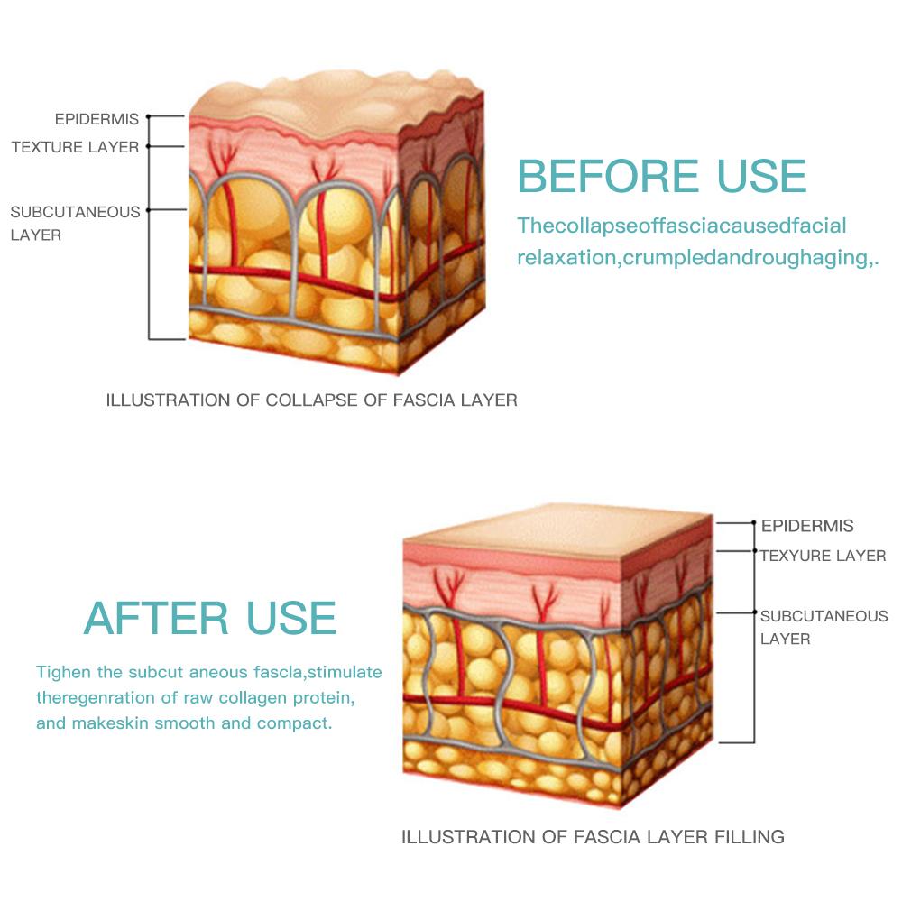 НОВЫЙ мини HiFu ультразвуковой RF EMS микротоковый лифтинг лица против морщин уход за кожей лица устройство красоты