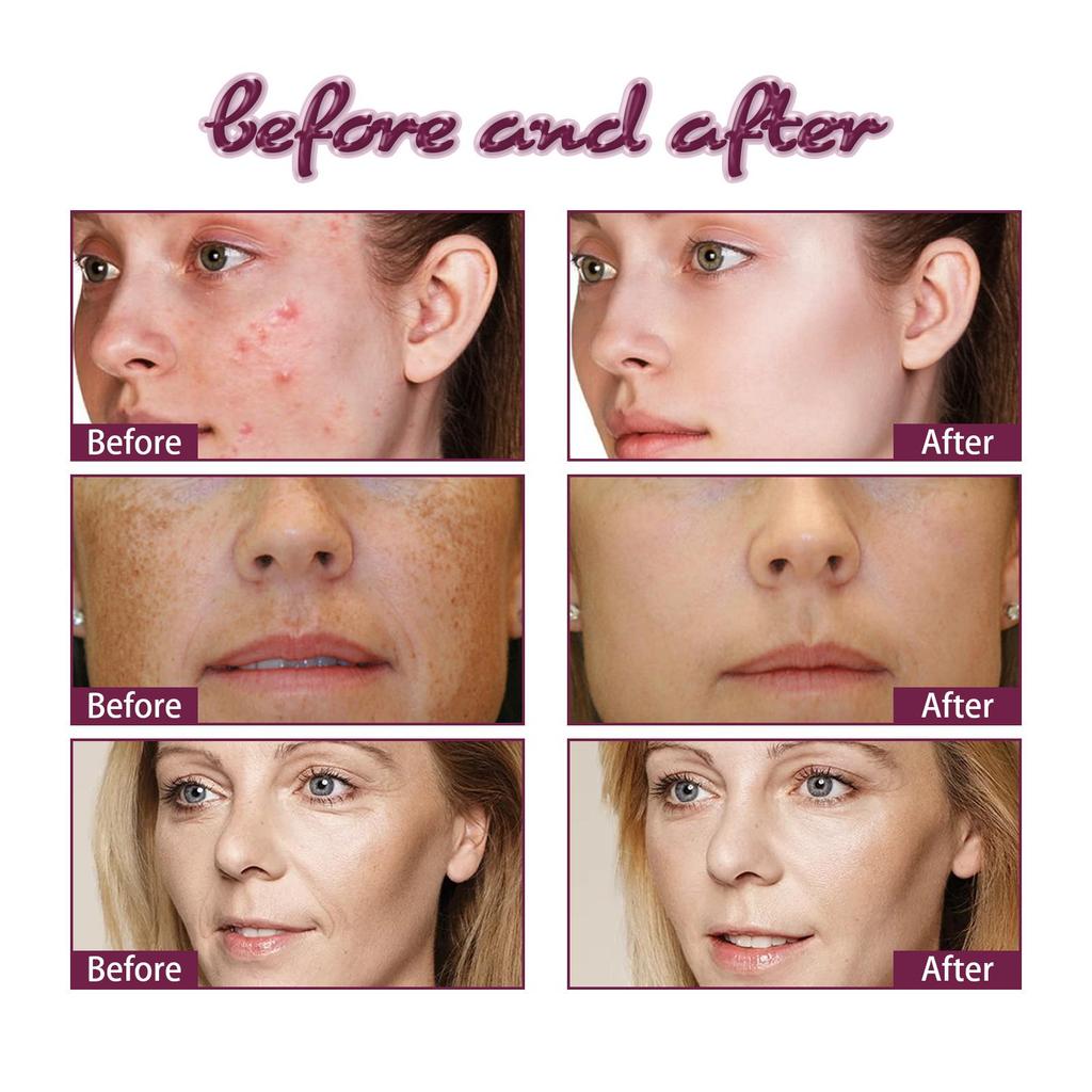 EELHOE Масло для лица «Бегония» уменьшает следы от прыщей, осветляет морщины, увлажняет и укрепляет кожу. Эфирное масло