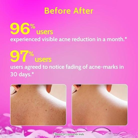 Chemist at play Гель для душа с 1% салициловой кислотой 473 мл | Без парабенов и SLS | Предотвращает появление прыщей на теле и неровностей кожи | Для мужчин и женщин