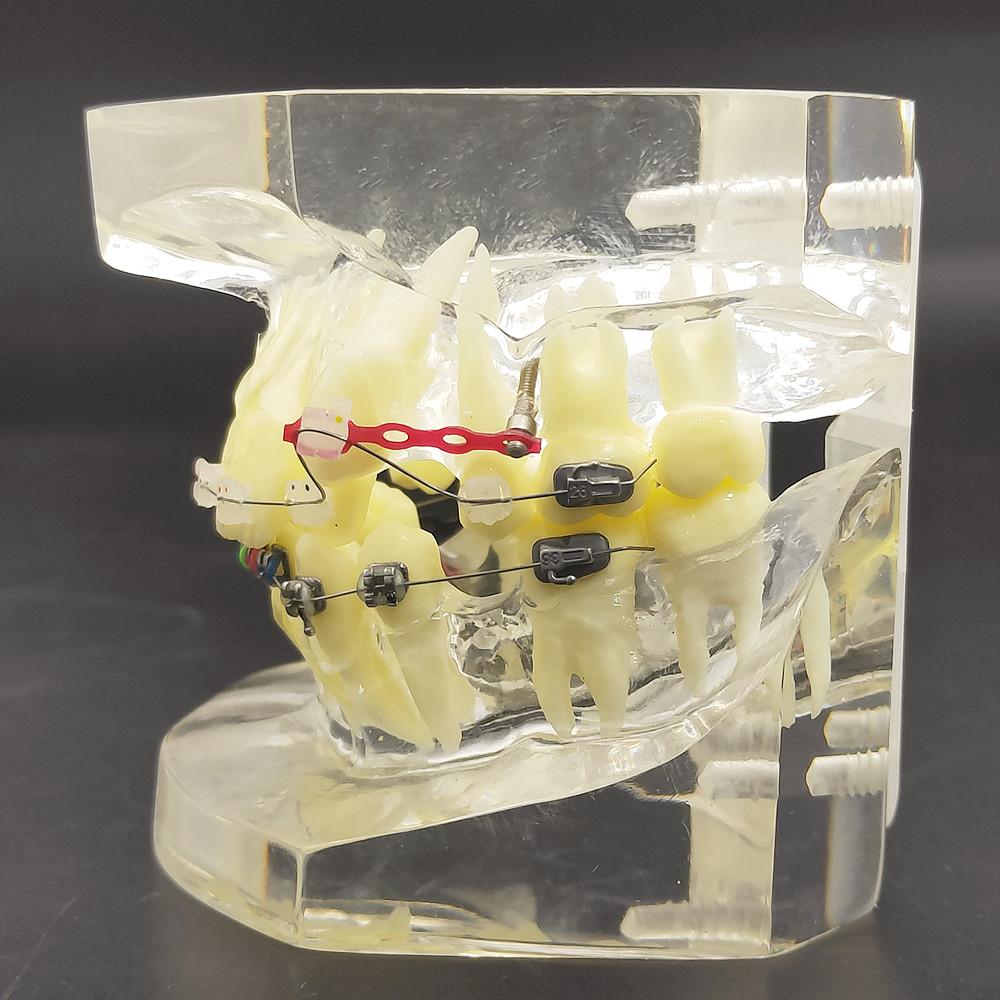 1 шт., прозрачная стоматологическая ортодонтическая модель прикуса с брекетами, буккальная трубка дуги для общения с пациентом