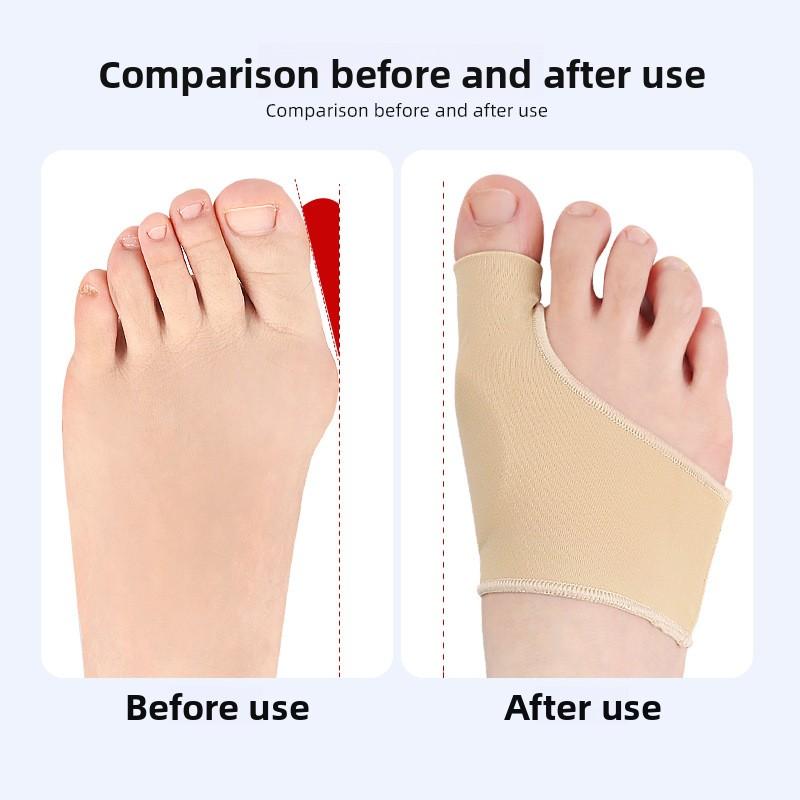 SEBS Повязка для ухода при вальгусной деформации большого пальца стопы, Косточка большого пальца, Защитная повязка при вальгусной деформации, Защитная повязка для большой стопы