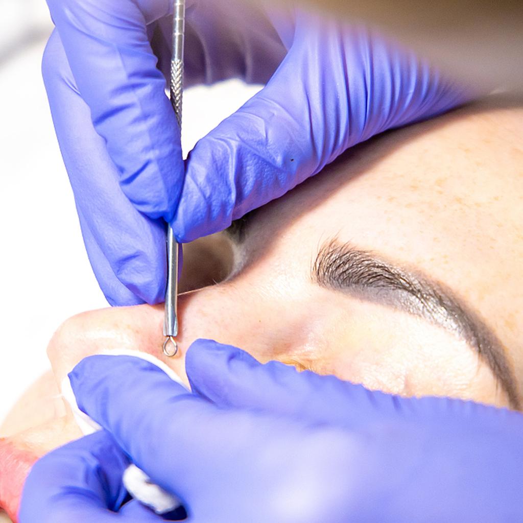 Набор инструментов для удаления черных точек, прыщей, поппера, прыщей, пятен, комедонов, прыщей, прыщей, белых угрей, лица, подбородка