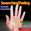 Мощный заживляющий крем для пилинга рук, специально для шелушения и трещин, глубокое восстановление поврежденной кожи