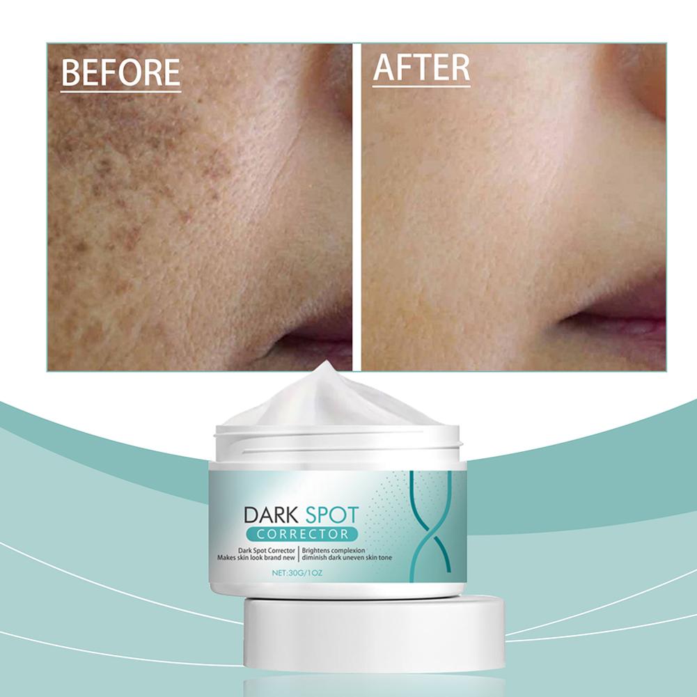 Ретинол Отбеливающий крем от веснушек Осветление тона кожи Осветление Увлажнение Гиалуроновая кислота F I0X3