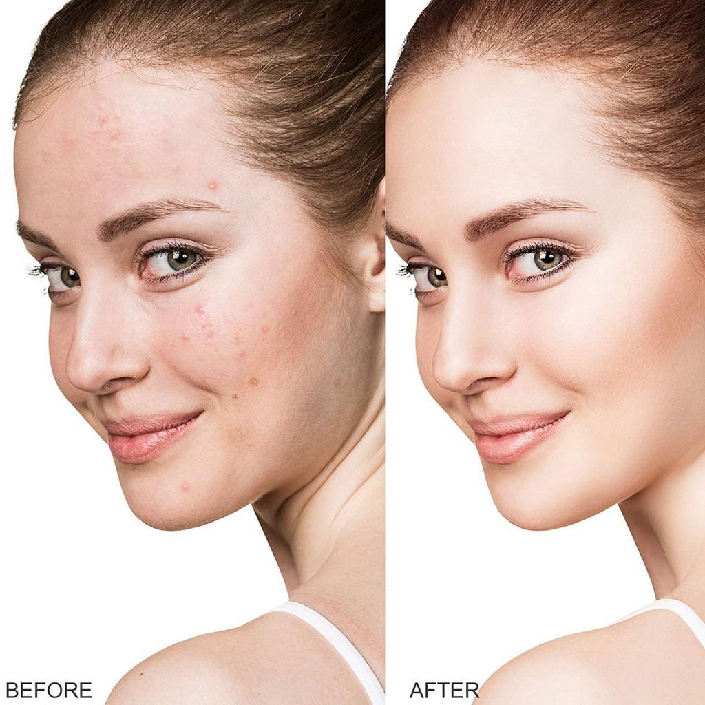 36 Acne Patch Концентрированный корректор от прыщей (инкапсулированный)