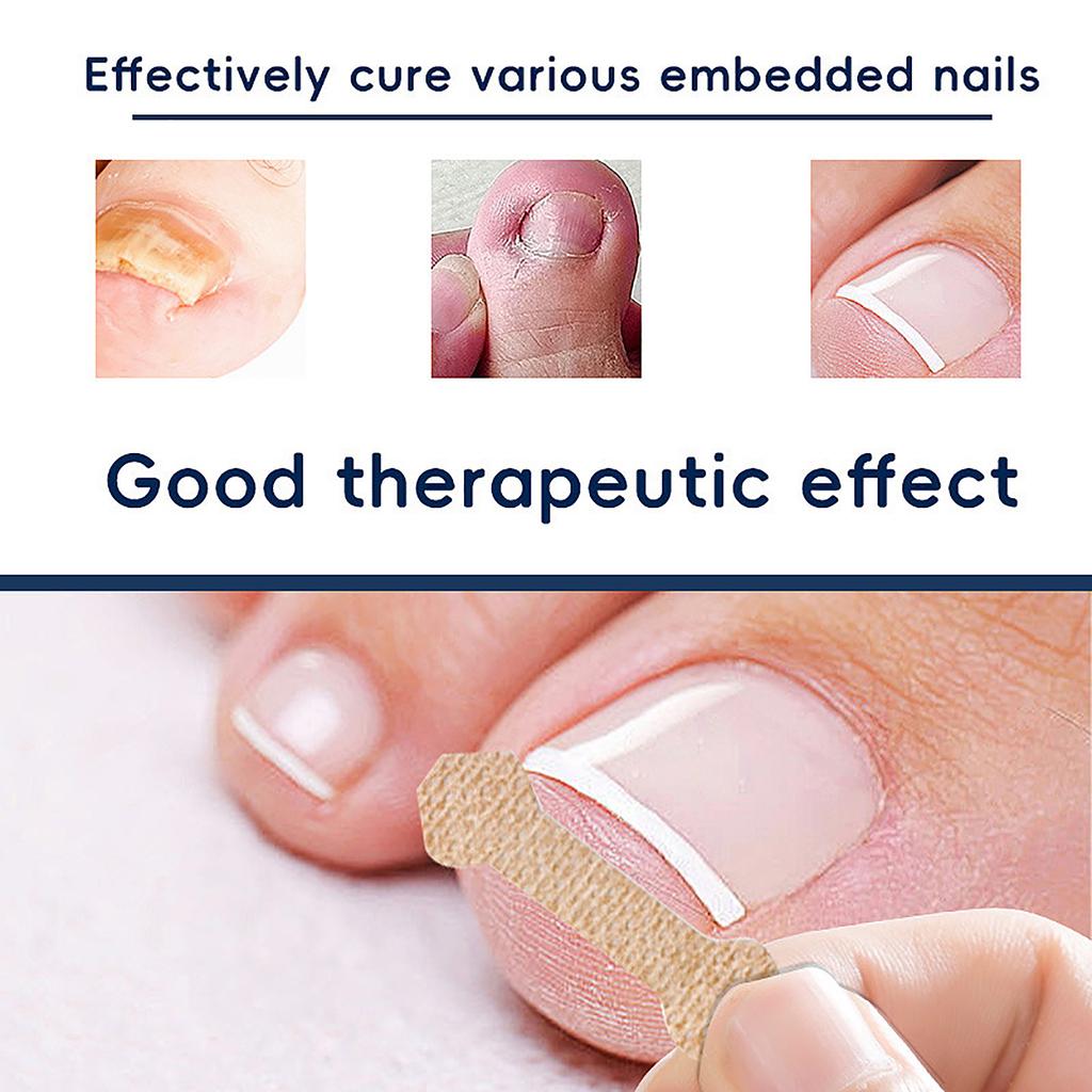 60PCS Nail Correction Patch Breathable Ingrown Toenail Sticker Nail Care Strips Customs Name: Plastic Patch
