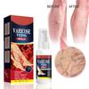 Vein Varicose Veins Spray, Vein Varicose Veins Spray, Vein Varicose Veins Spray 30ml