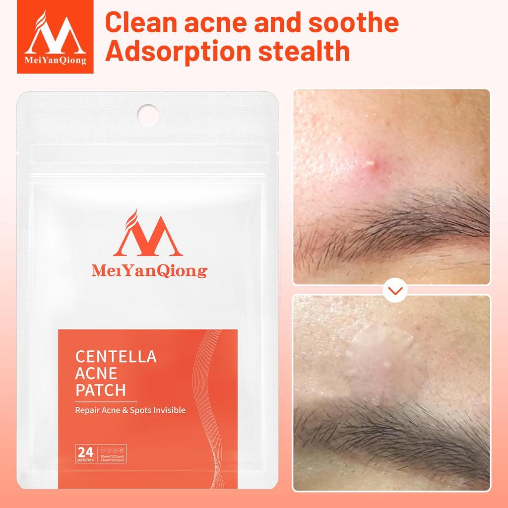 MeiYanQiong Centella Acne Patch Stickers Acne Treatment Pimple Remover Tool Blemish Spot Facial Mask Skin Care Waterproof 24 Patches