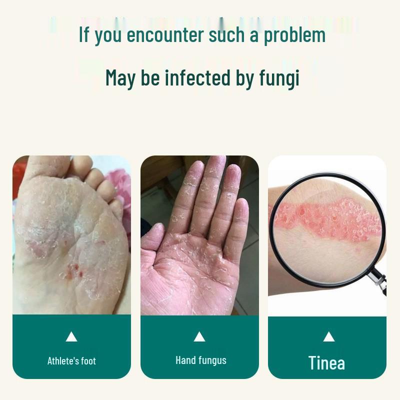 Спрей для ног Tuoneng с хитозаном от зуда, шелушения и грибковых инфекций