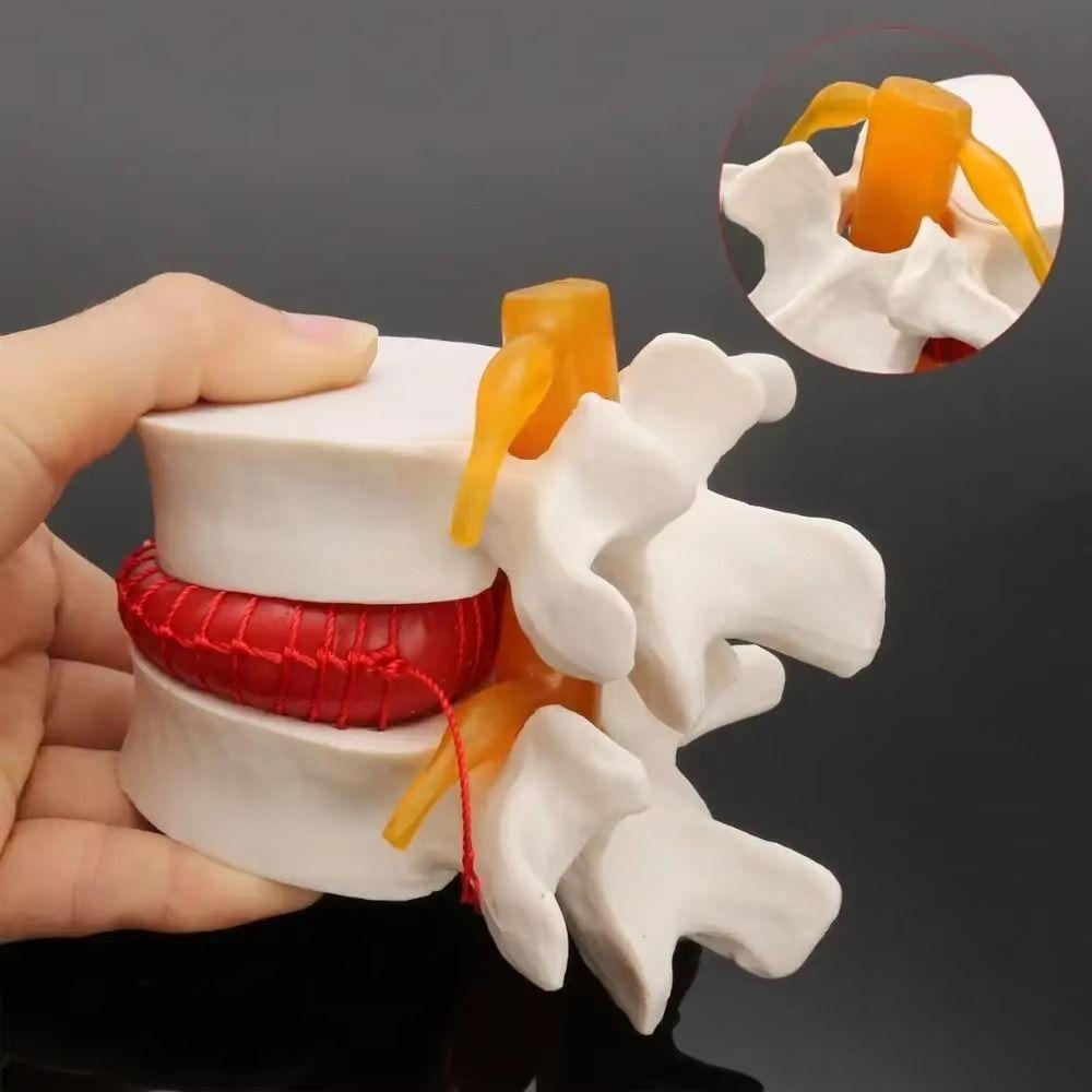 3D Model Lumbar Model 1.5X Enlarge Lumbar Disc Herniation Teaching Tool Nursing