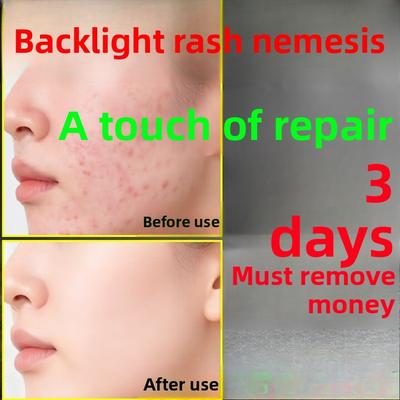 Крем от акне для детей, Гель для лечения прыщей для лица, лба, Безопасен для всех типов кожи