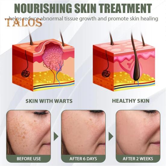 Гель-корректор для мгновенного удаления родинок и пятен, крем для всех типов кожи, натуральные экстракты, 50 г, увлажняющий гель для удаления темных пятен на теле, восстановление кожи, уменьшение