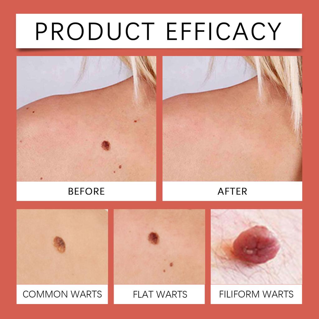 Патчи для ухода за кожей для плоских родинок, патчи для ухода за лицом и кожей вокруг глаз эффективно уменьшают кератин и разглаживают кожу.