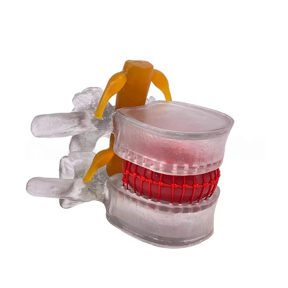 3D Model Lumbar Model 1.5X Enlarge Lumbar Disc Herniation Teaching Tool Nursing