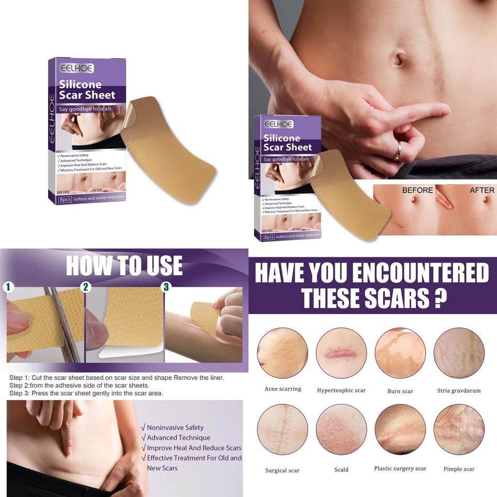 Eelhoe Silicone Scar Patches For Reducing Pregnancy And C-section Scars Effectively
