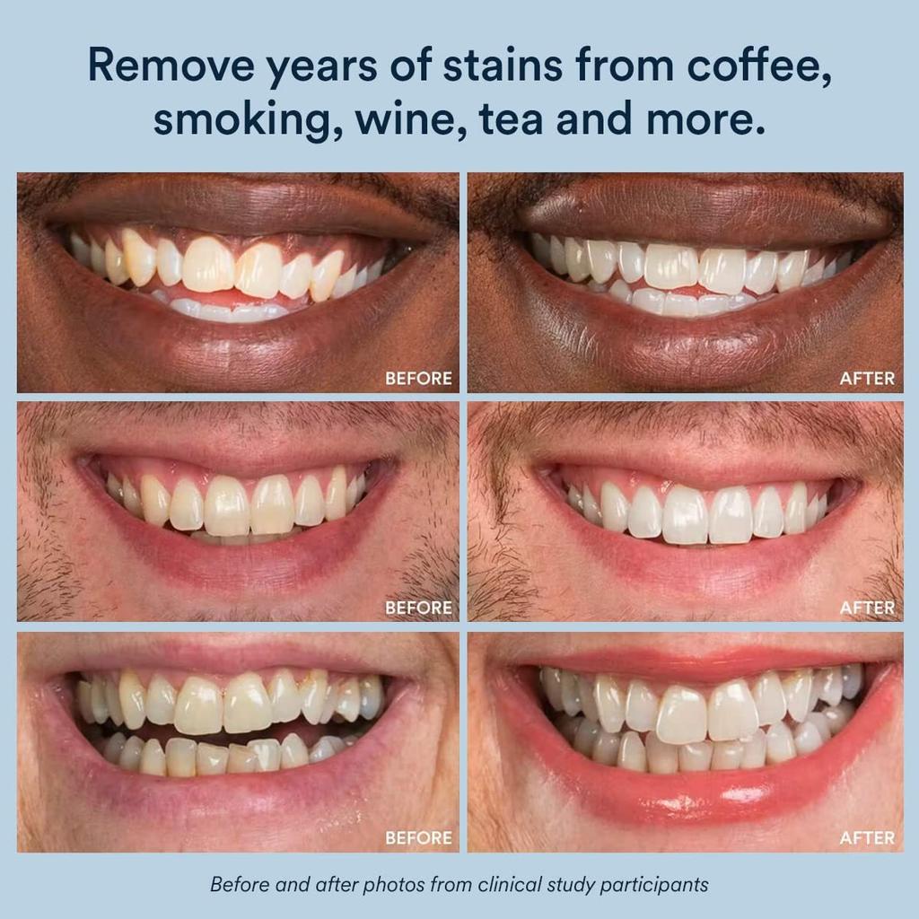 Полоски для отбеливания зубов 14 процедур, безопасны для эмали для мгновенной белой улыбки, простой в применении набор для отбеливания зубов с 28 полосками (14 Верхних и 14 Нижних)