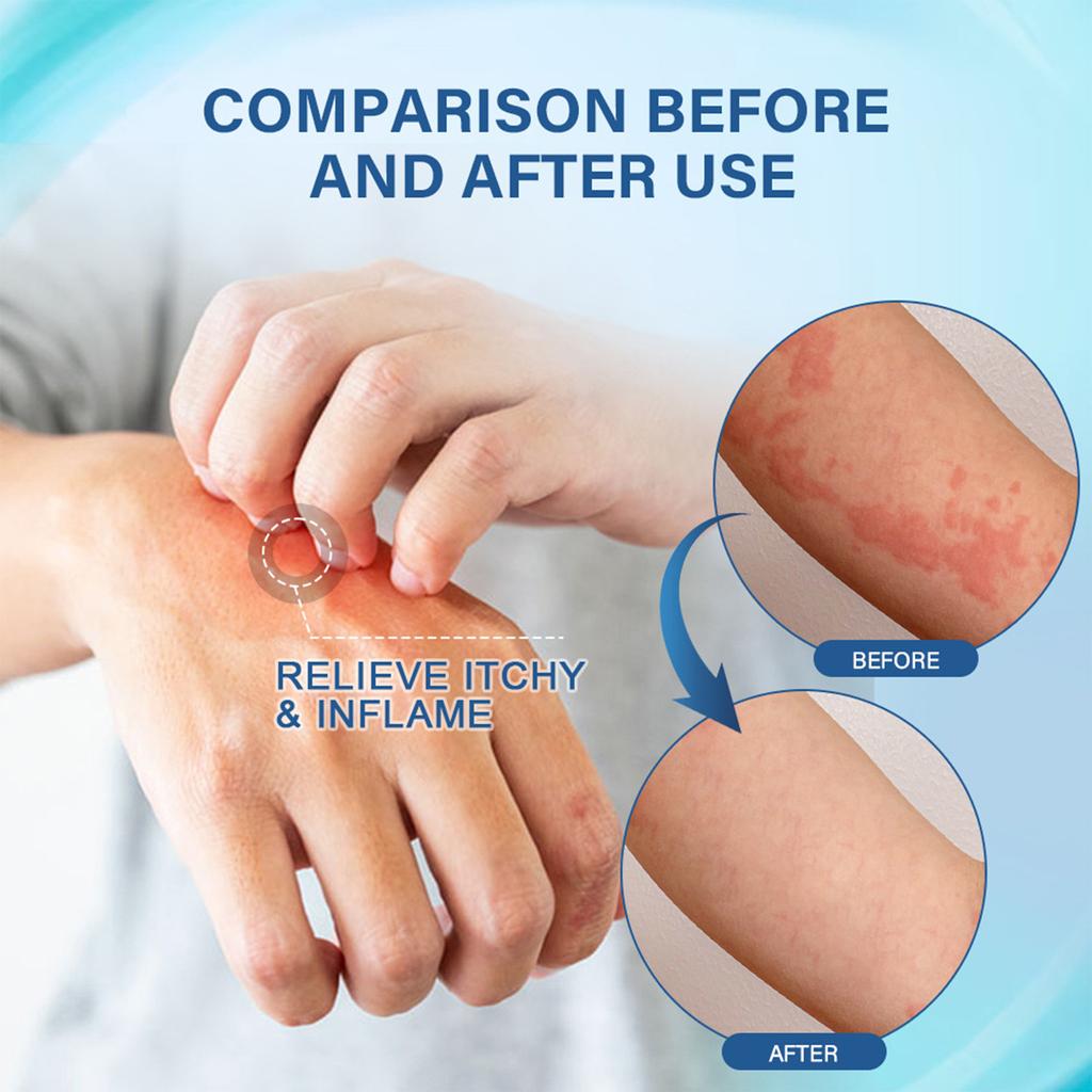Крем для ухода за экземой, дерматитом, крапивницей, мазью от зуда кожи, массажным пластырем
